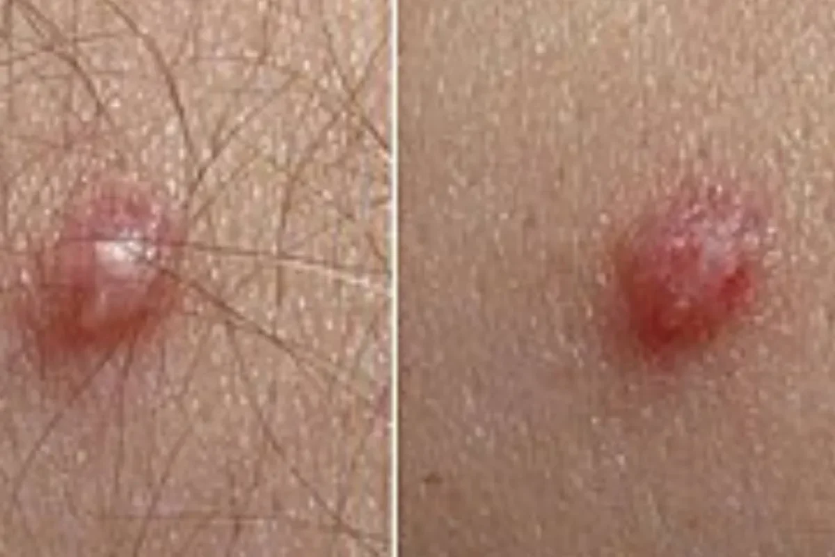 J'ai le papillomavirus, est-ce que je suis contagieuse ?