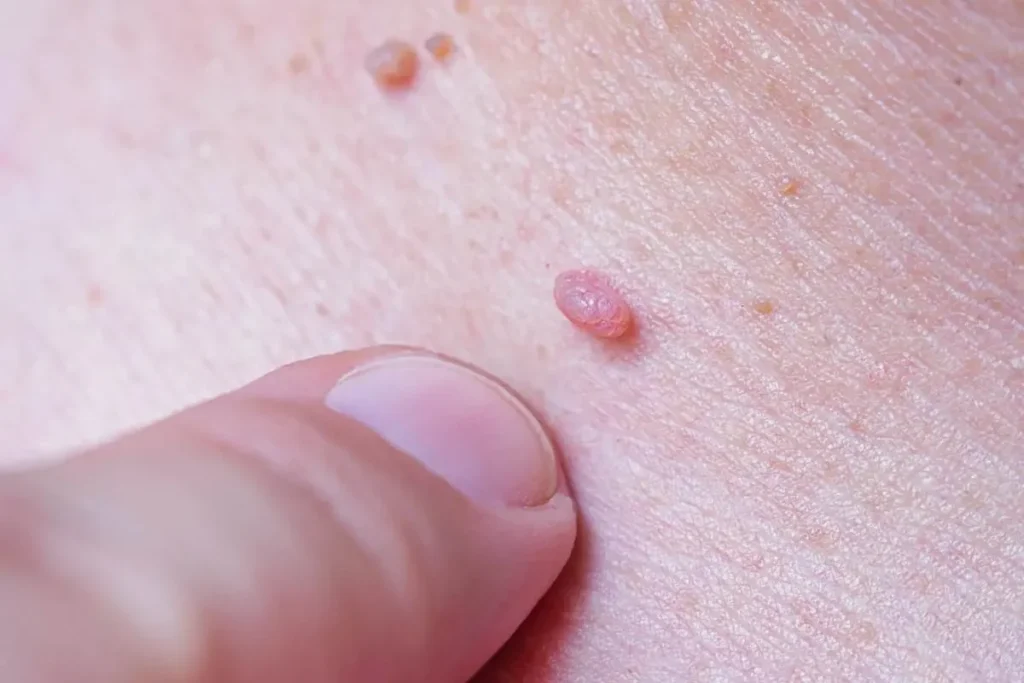 J'ai le papillomavirus, est-ce que je suis contagieuse ?